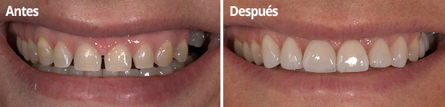 Tratamiento de dientes separados en Clínica Dental Vallecas
