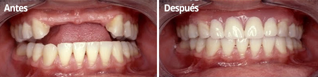 Tratamiento de falta de piezas dentales en Clínica Dental Vallecas