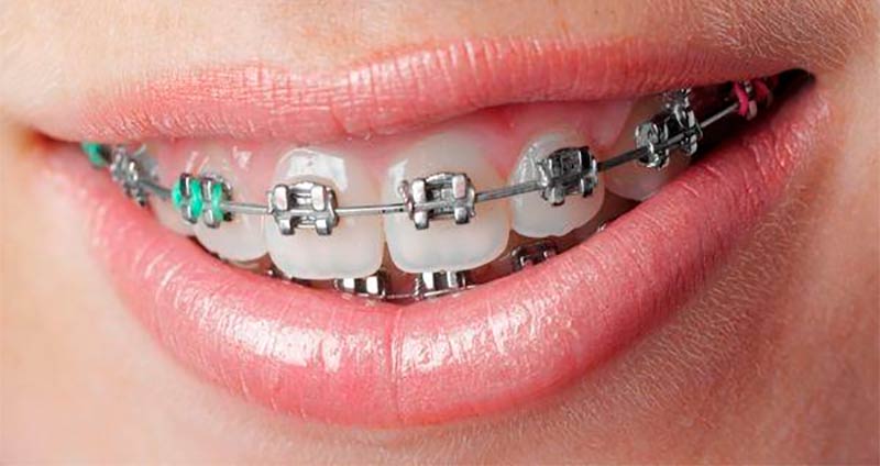 Brakets metálicos en Clínica Dental Vallecas