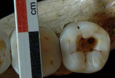 Intervenciones dentales prehistóricas