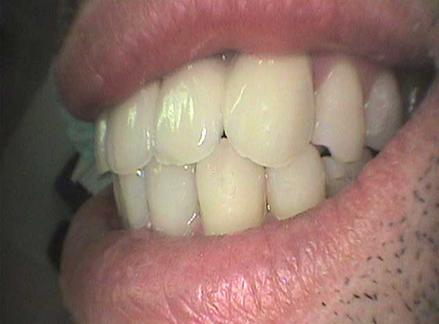 Estética dental con puentes de porcelana. Después