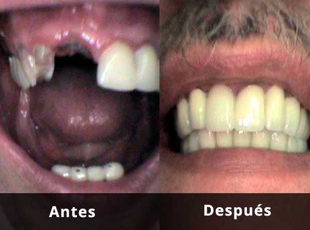 Rehabilitación total con fundas de porcelana e implantes en Clínica Dental Vallecas