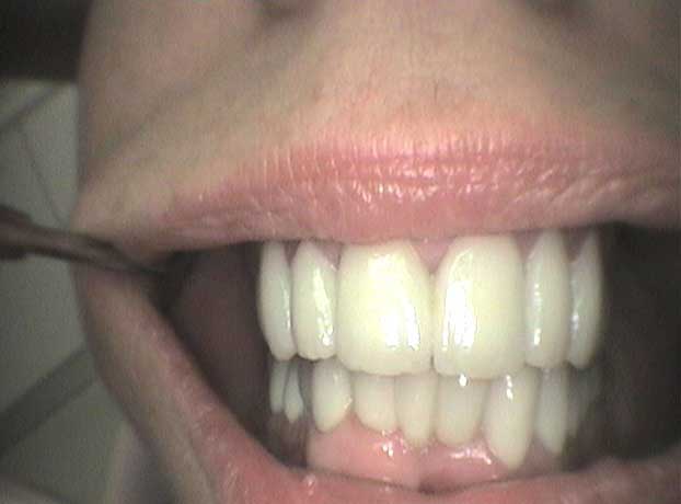Rehabilitación arcada superior e inferior con coronas de circonio en Clínica Dental Vallecas (después - 2)