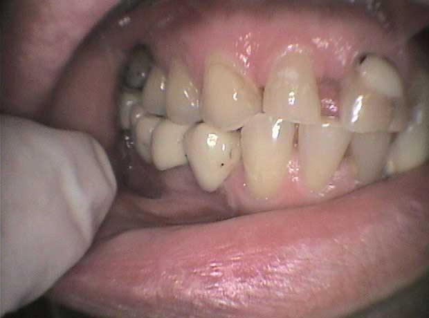 Rehabilitación en porcelana en Clínica Dental Vallecas (antes - 2)