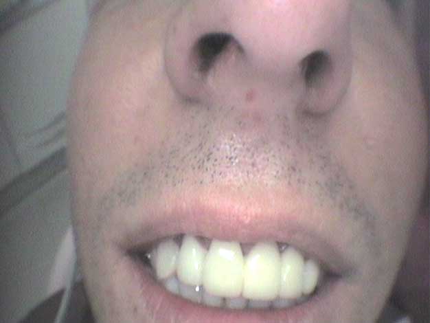 Estética con coronas de circonio en Clínica Dental Vallecas (antes - 2)