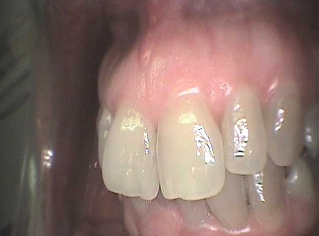 Estética con coronas de circonio en Clínica Dental Vallecas (antes - 2)
