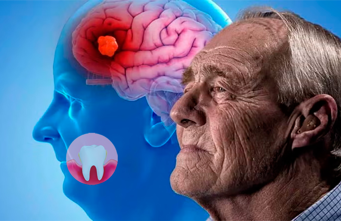 Periodontitis, Alzhéimer e ictus ¿hay relación?