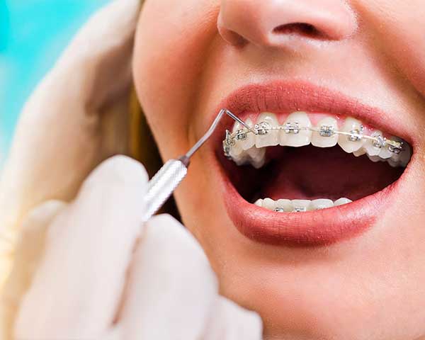 Ortodoncia en Clínica Dental Vallecas