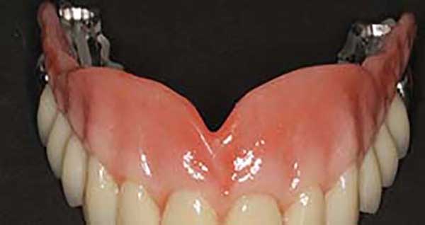 Implante prótesis removible o sobredentadura en Clínica Dental Vallecas