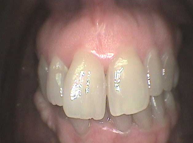 Estética con coronas de circonio en Clínica Dental Vallecas (antes - 3)