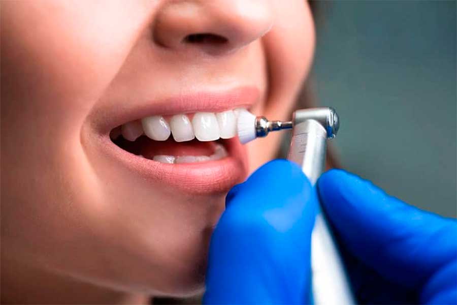 Tartrectomia, profilaxis dental o limpieza dental en Clínica Dental Vallecas
